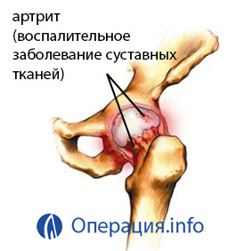 a csípőízület posztraumás artrózisa