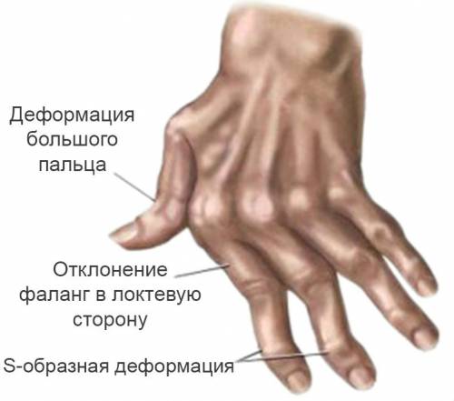 artrita reumatoidă a articulațiilor mici ale piciorului