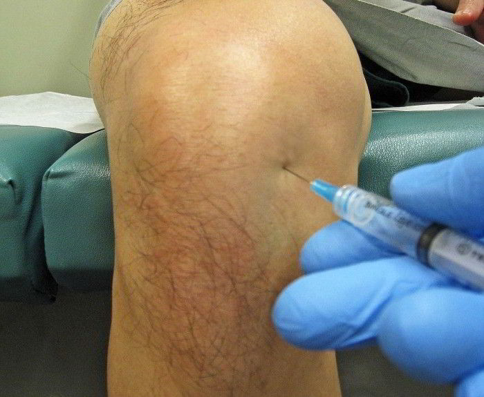 cum să ameliorați durerea în osteoartrita genunchiului 2 3 artroze ale articulației șoldului