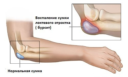 inflamația sacului sinovial al articulației umărului)