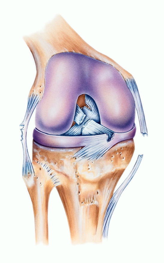 deteriorarea parțială a ligamentului încrucișat al genunchiului