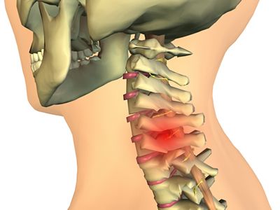 Xefocam-rapid pentru dureri articulare Durerea Articulatiilor - Tipuri, Cauze si Remedii