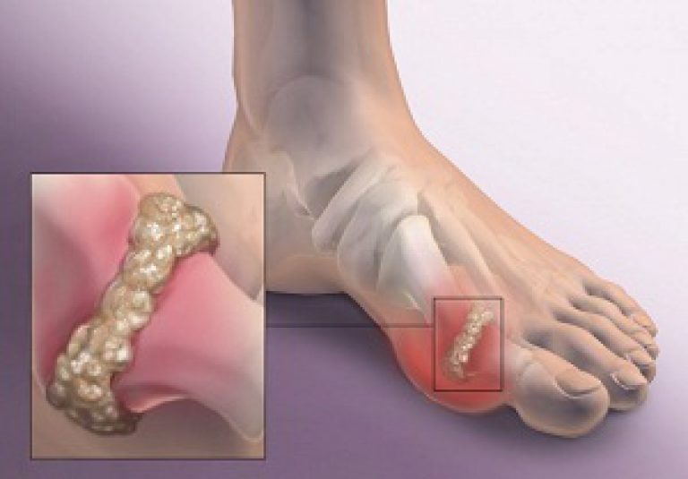 tratamentul artrozei genunchiului cu ulei de camfor tratamentul fisurilor gleznei