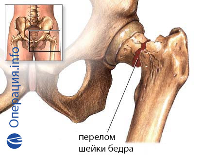 a láb posztraumás artrózisa