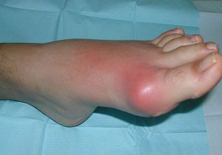 boli ale articulațiilor picioarelor la bărbați unguent levomekol unguent